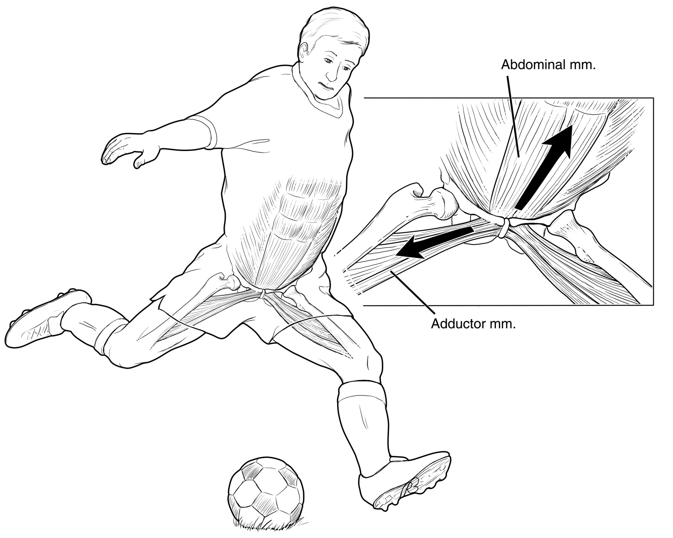 بیماری پوبالژیا بیماری فوتبالیست ها
